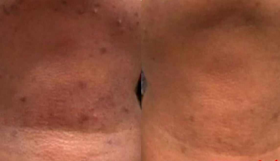 Turmeric Kojic Dark Spot Soap