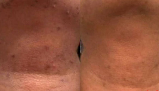 Turmeric Kojic Dark Spot Soap