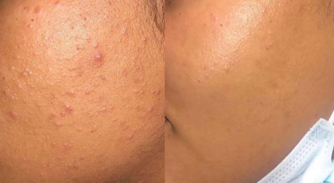 Turmeric Kojic Dark Spot Soap